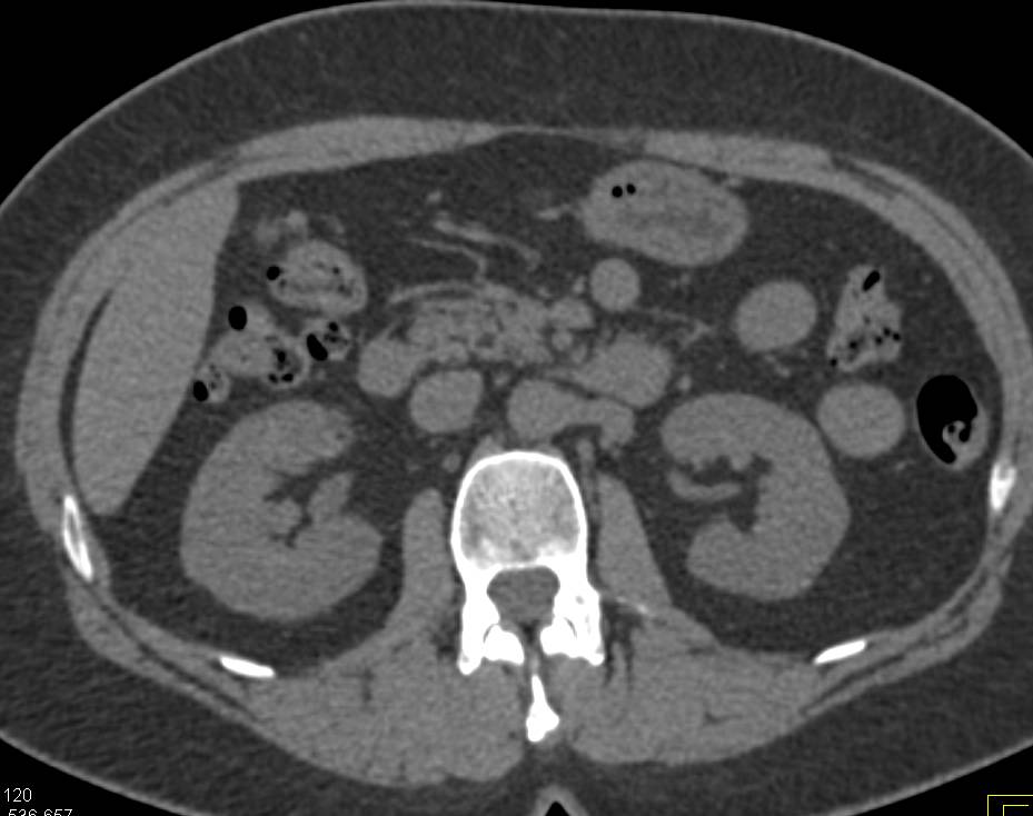 1 cm Renal Cell carcinoma Right Kidney Best Seen on Delayed Phase Images - CTisus CT Scan