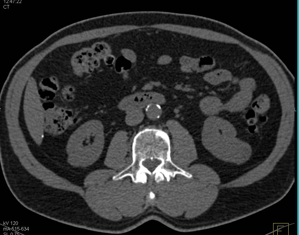 Multiple Displays of a Left Papillary Renal Cell Carcinoma with a Right Adrenal Adenoma - CTisus CT Scan