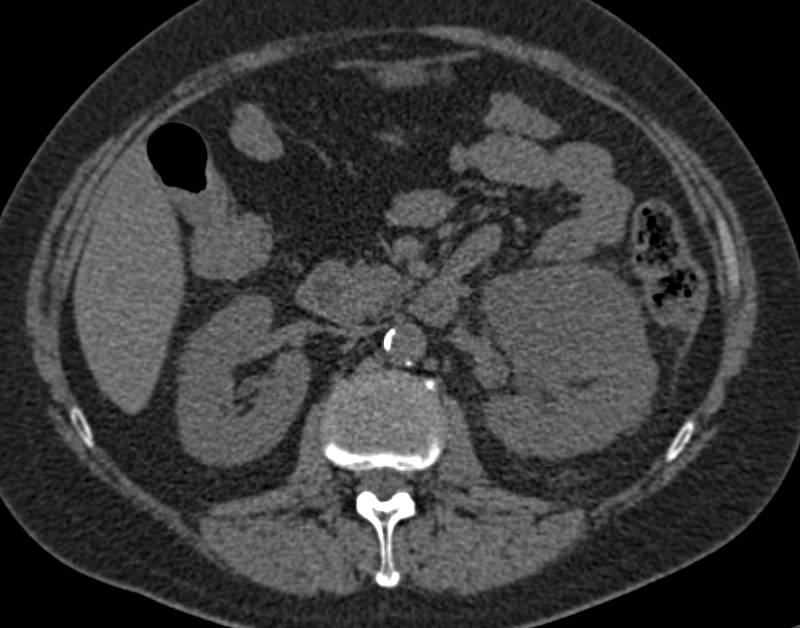 Cystic Renal Cell Carcinoma Left Kidney - CTisus CT Scan