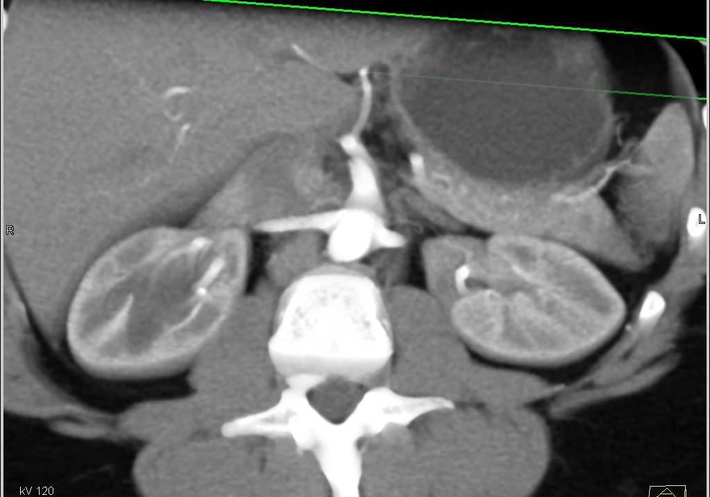 CTA of the Renal Arteries - CTisus CT Scan