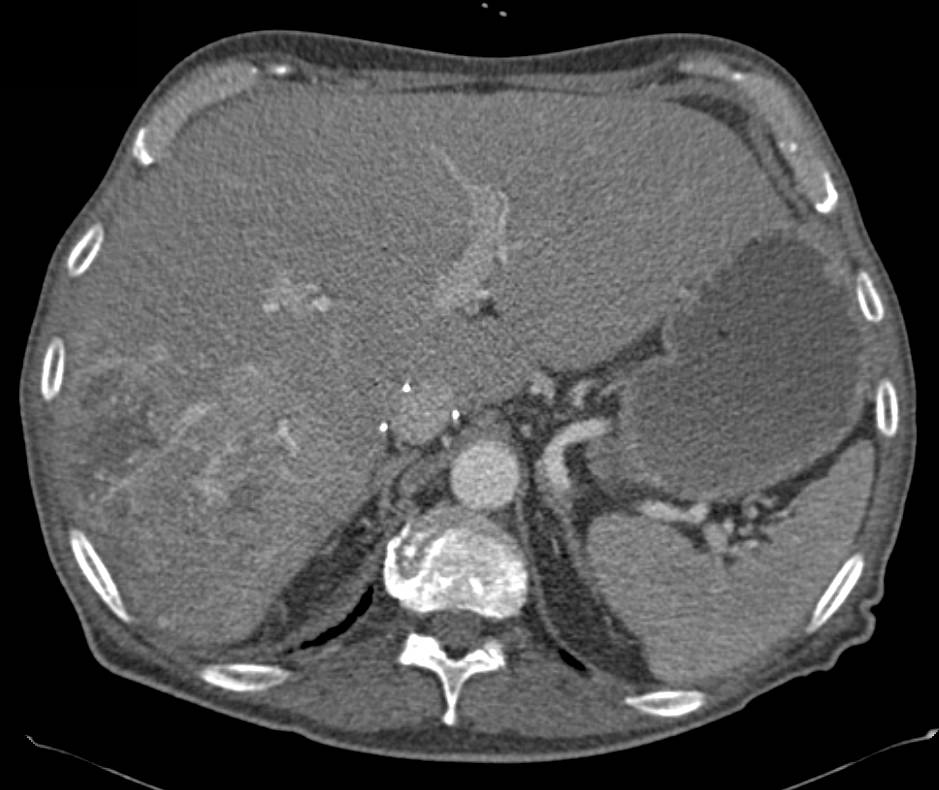 Renal Cell Carcinoma with Liver Metastases - CTisus CT Scan