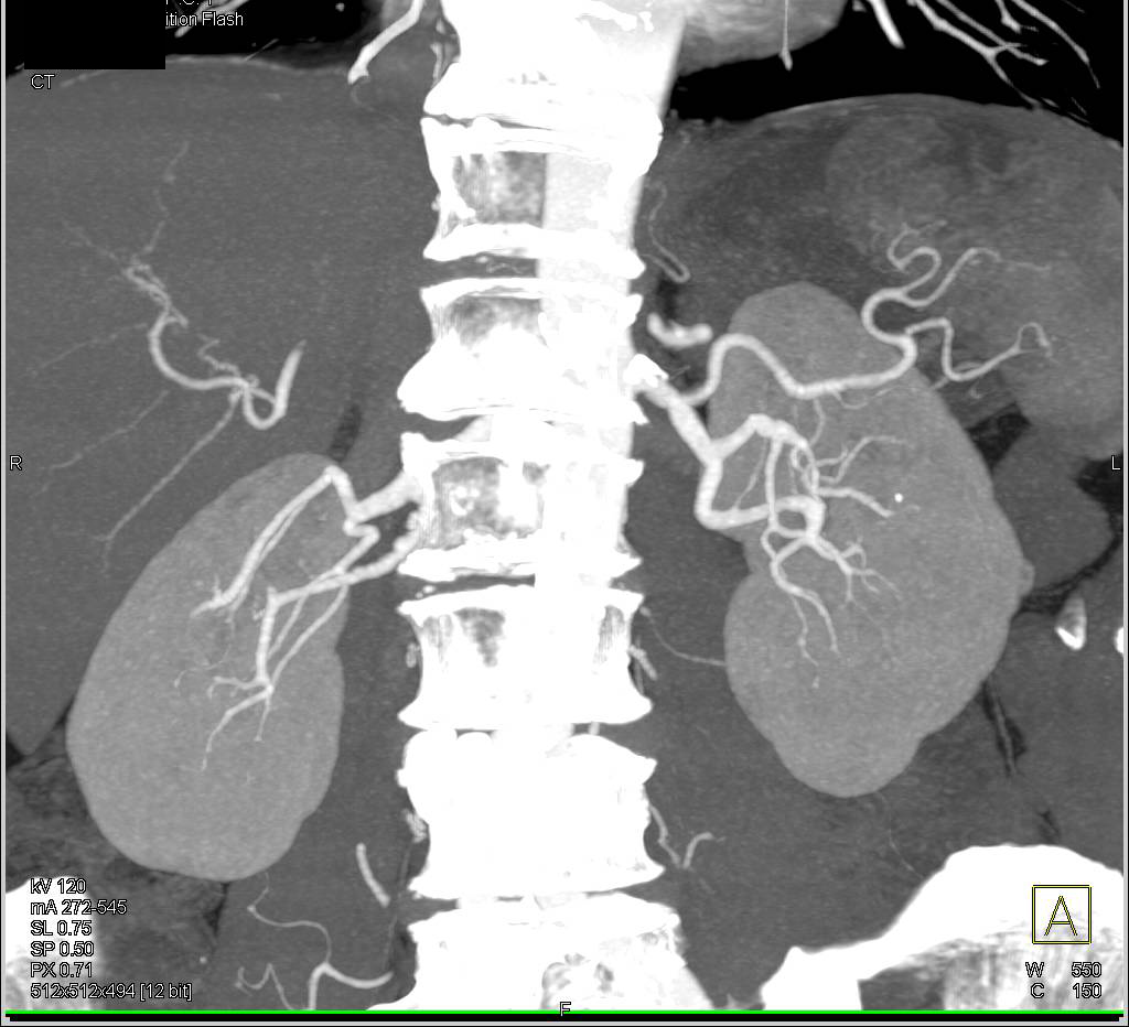 1 cm Left Renal Cell Carcinoma - CTisus CT Scan