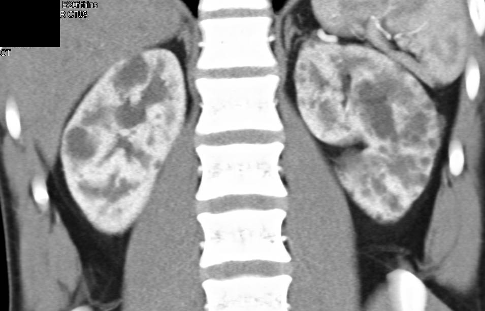 Form of Polycystic Renal Disease - CTisus CT Scan