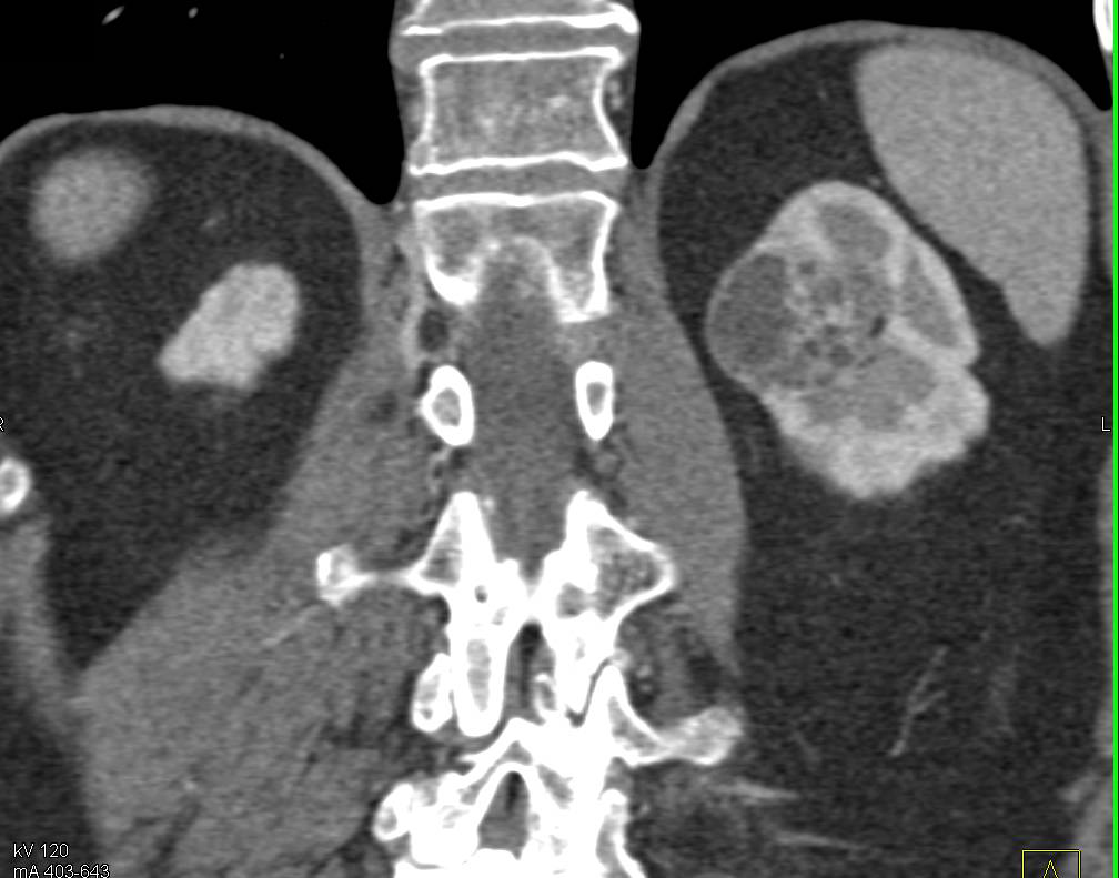 Cystic Renal Cell Carcinoma Left Kidney - CTisus CT Scan