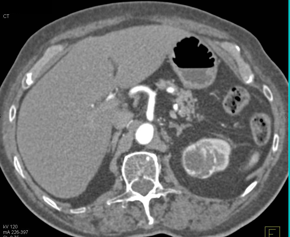 Cystic Renal Cell Carcinoma Left Kidney Upper Pole - CTisus CT Scan