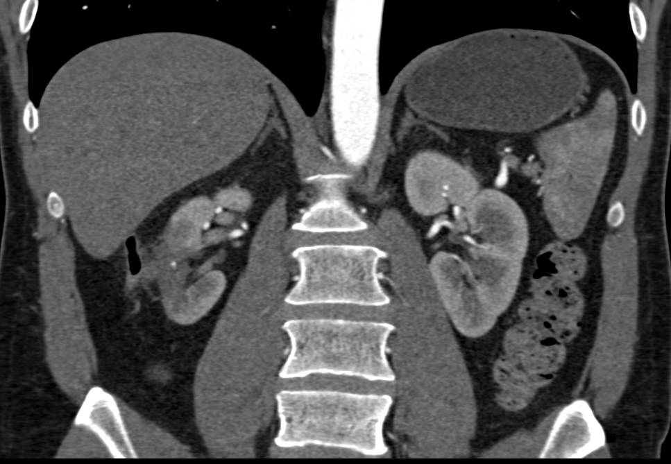 Post Radiofrequency Ablation (RFA) Changes Right Kidney - CTisus CT Scan