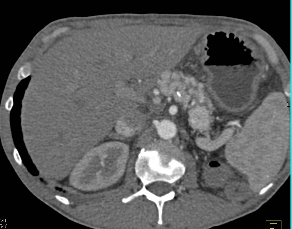 Renal Cell Carcinoma with Left Nephrectomy and Metastases to the Pancreas and Mediastinum. Note the Metastases are Vascular. - CTisus CT Scan