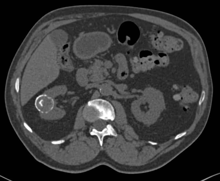 Calcified Renal Cyst Without Any Enhancement - CTisus CT Scan