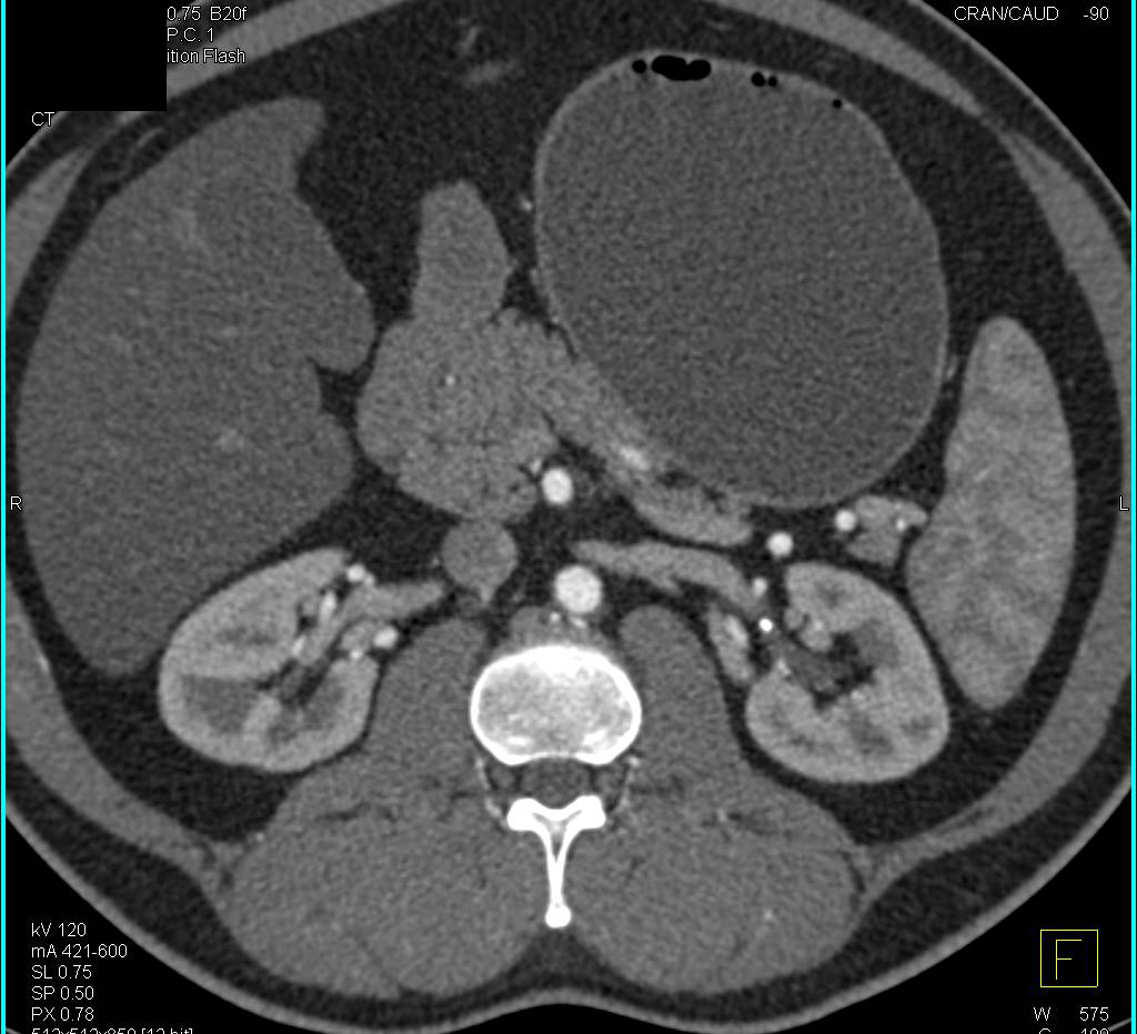 Normal CT Urogram - CTisus CT Scan