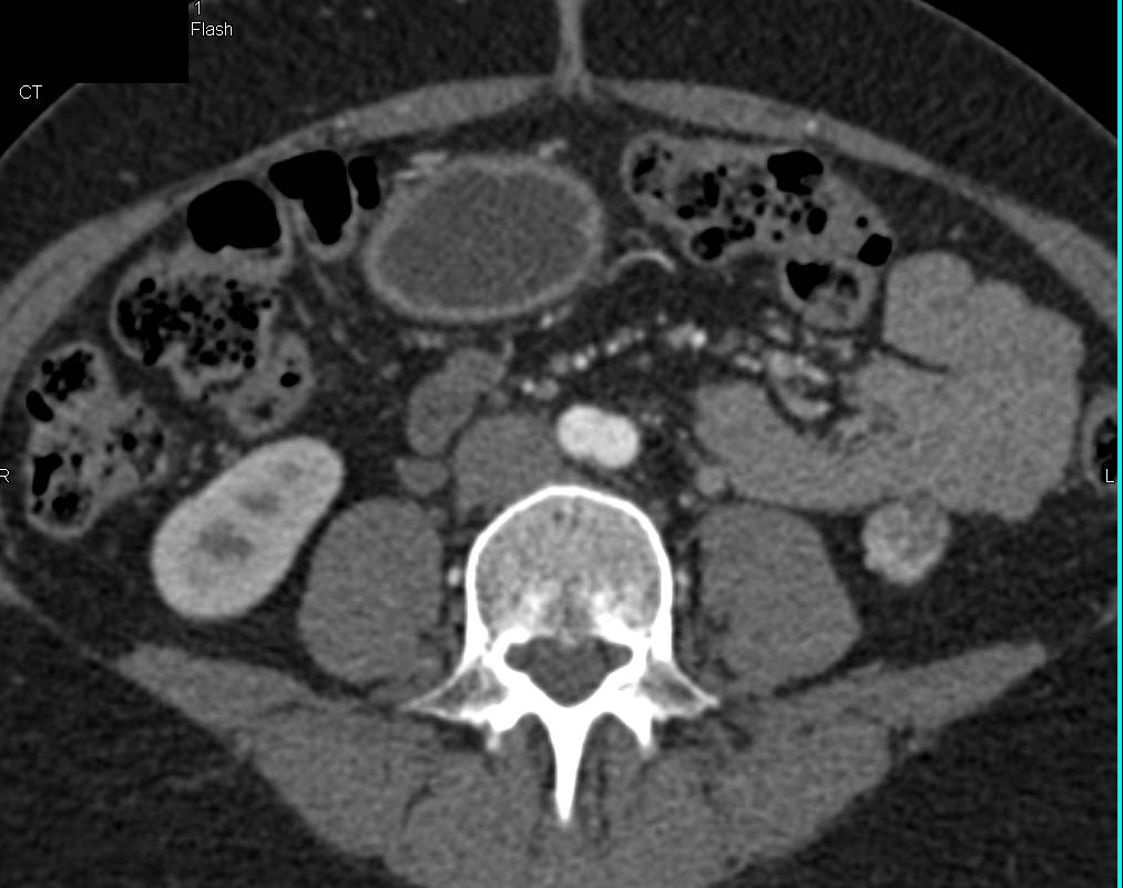 Incidental 1 cm Left Renal Cell Carcinoma (lower pole) - CTisus CT Scan