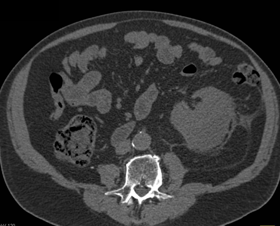 Perirenal Hematoma - CTisus CT Scan