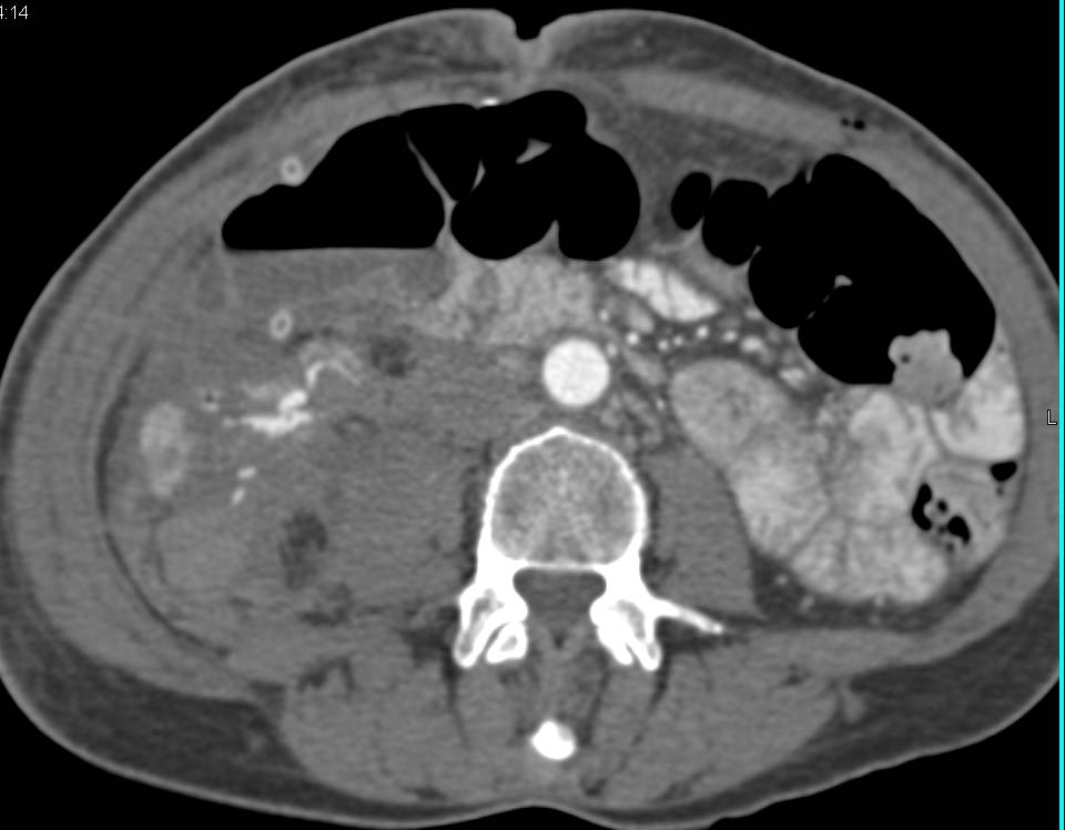 Renal Laceration with Contrast Extravasation - CTisus CT Scan