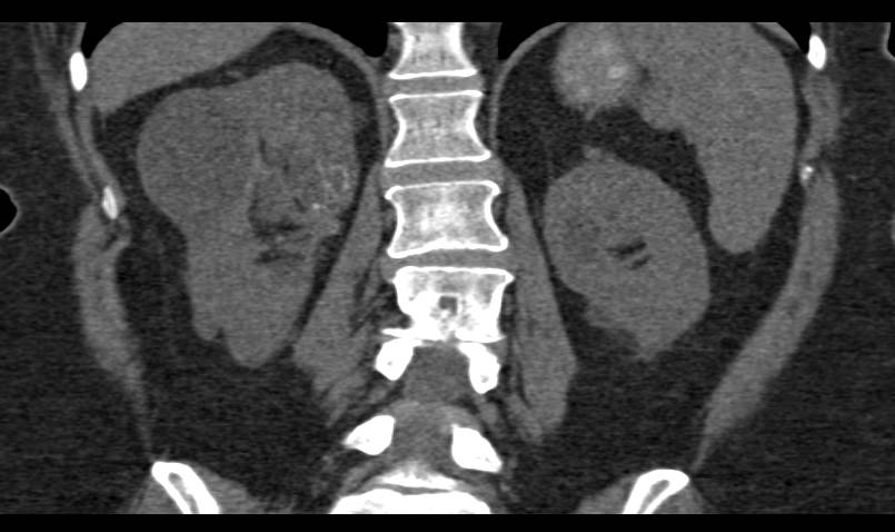 Polycystic Renal Disease - CTisus CT Scan