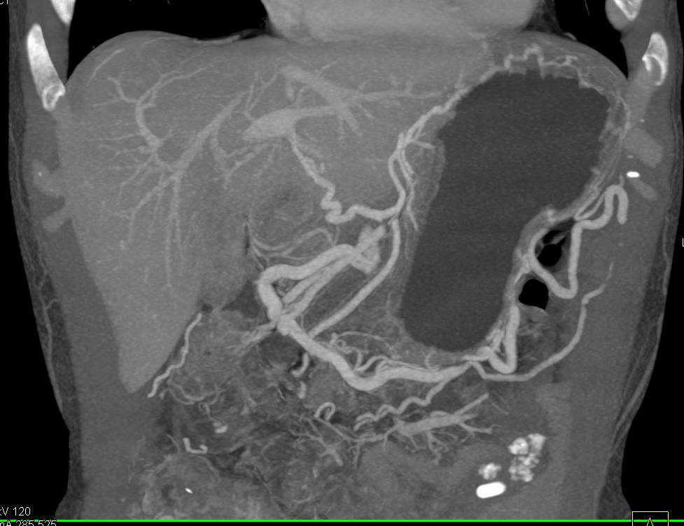 Renal Infarcts in a Patient with Autimmune Pancreatitis - CTisus CT Scan