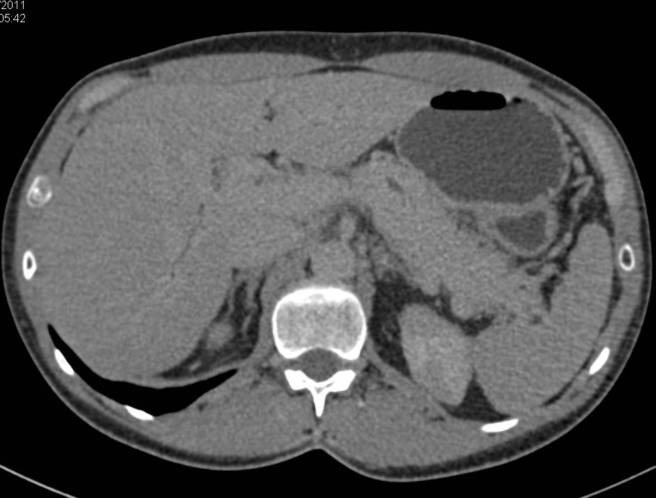 Renal Infarcts Bilaterally - CTisus CT Scan