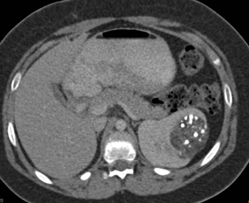 Wilms Tumor Previously Treated with Embolization - CTisus CT Scan