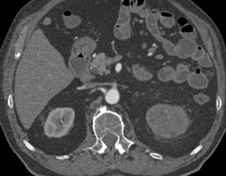 Transitional Cell Carcinoma Left Kidney with Renal Vein Invasion - CTisus CT Scan