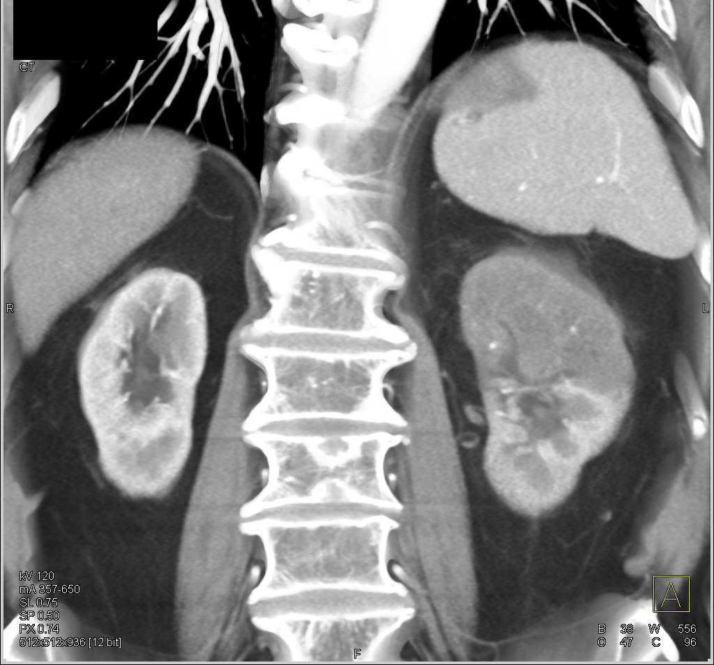 Transitional Cell Carcinoma Left Kidney - CTisus CT Scan