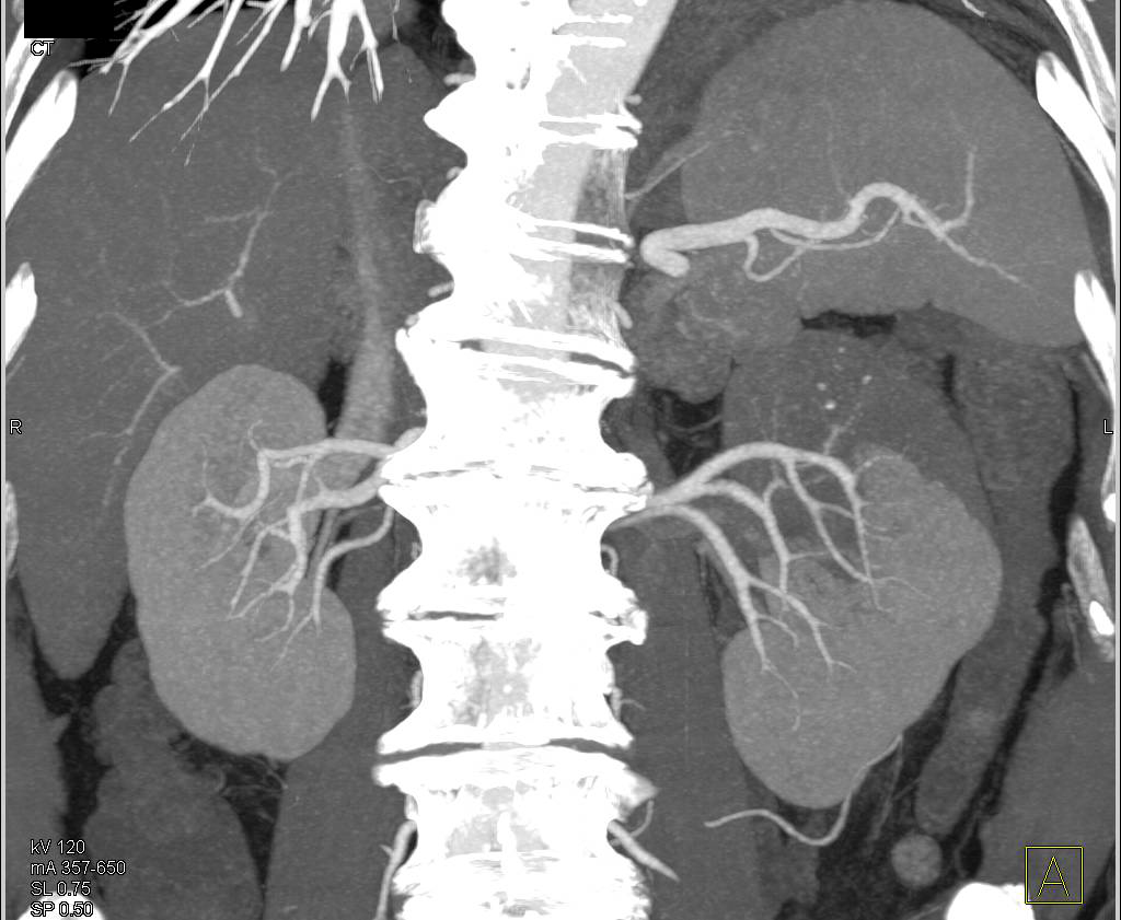 file-clear-cell-papillary-renal-cell-carcinoma-high-mag-jpg