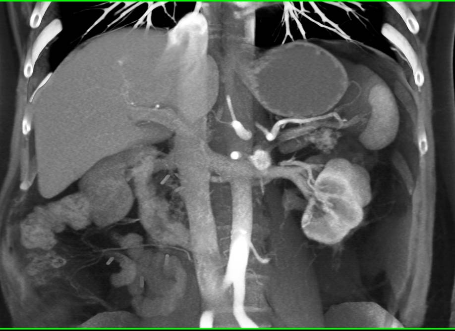 Recurrent Renal Carcinoma in Nodes - CTisus CT Scan