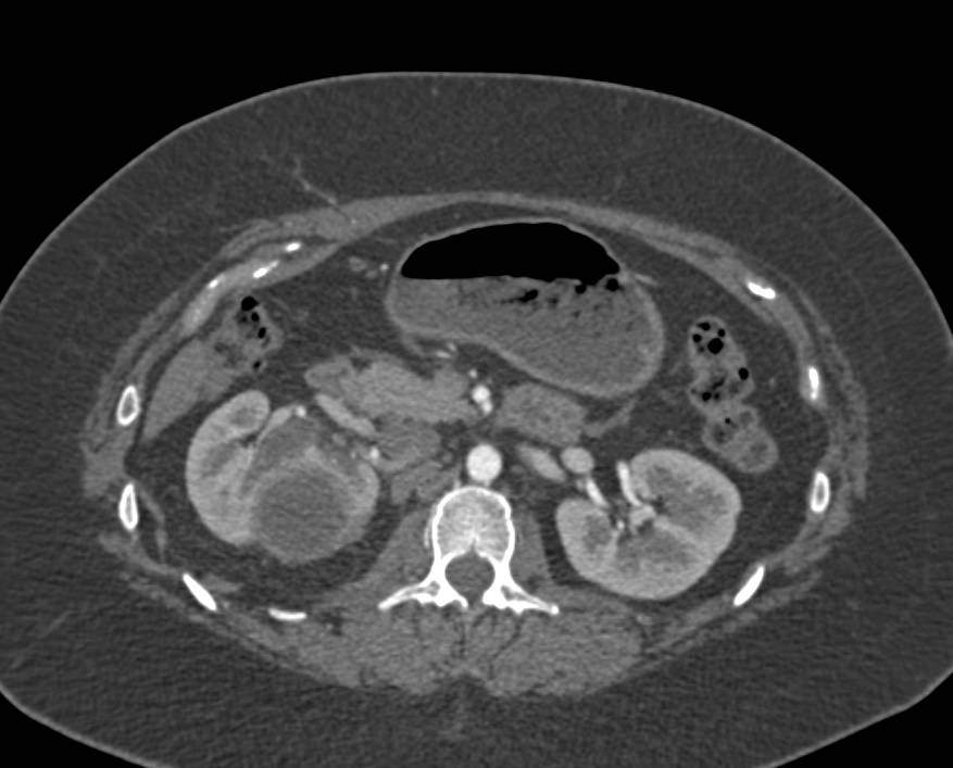 Renal Abscess Simulates a Necrotic Renal Cell carcinoma. Biopsy confirmed on Ultrasound guided biopsy - CTisus CT Scan