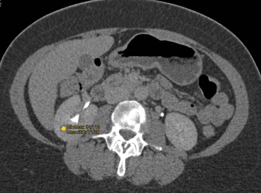 Renal Cell Carcinoma Recurrence with Multifocal Liver Disease - CTisus CT Scan