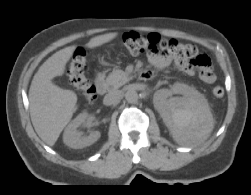 Renal Cell Carcinoma Presents as a Spontaneous Renal Bleed - CTisus CT Scan