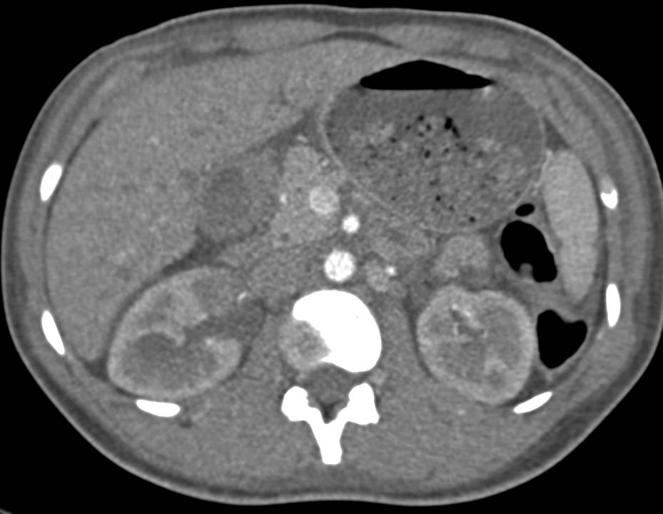 Renal Abscess Lower Pole Right Kidney - CTisus CT Scan