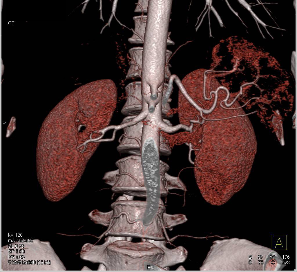 Normal Renal Arteries - CTisus CT Scan