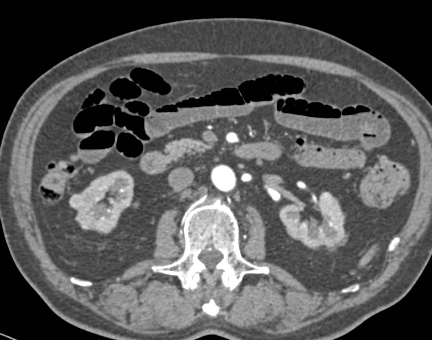 Incredible Case of Bilateral Renal Cell Carcinomas - CTisus CT Scan