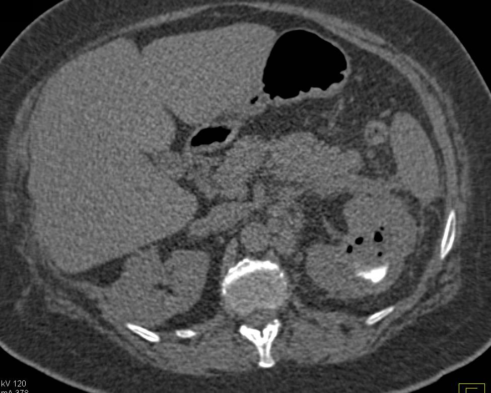 Left Renal Abscess - CTisus CT Scan