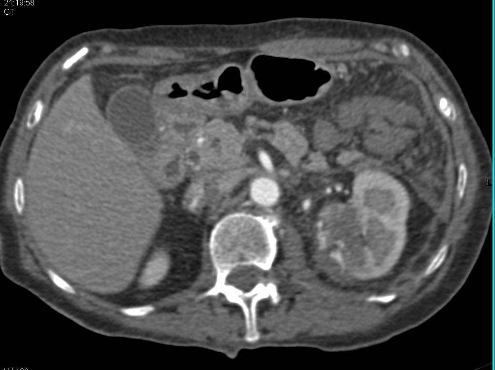 Hematoma Near Upper Pole Left Kidney Following Partial Nephrectomy - CTisus CT Scan