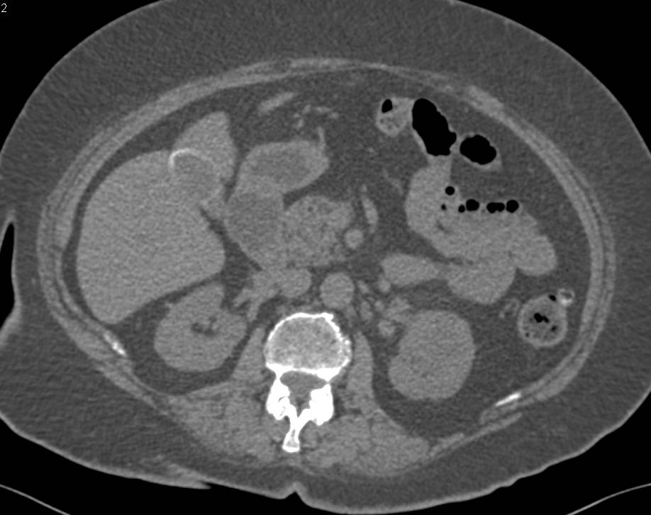 Cystic Renal Cell Carcinoma Left Kidney - CTisus CT Scan