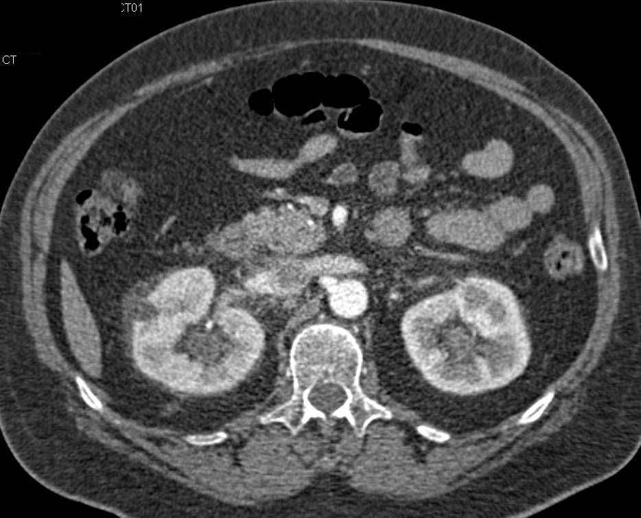 Infiltration of Both Ureters was Proven to be Transitional Cell Carcinoma - CTisus CT Scan