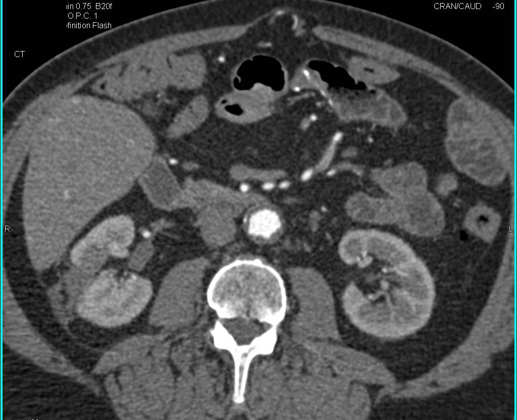 Post Radiofrequency Ablation (RFA) Changes Right Kidney with No Recurrence - CTisus CT Scan