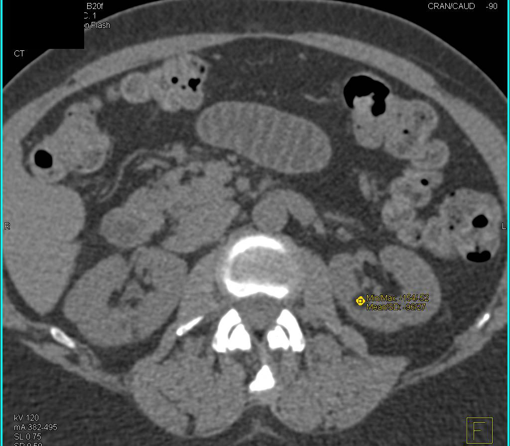 Renal Angiomyolipoma - CTisus CT Scan