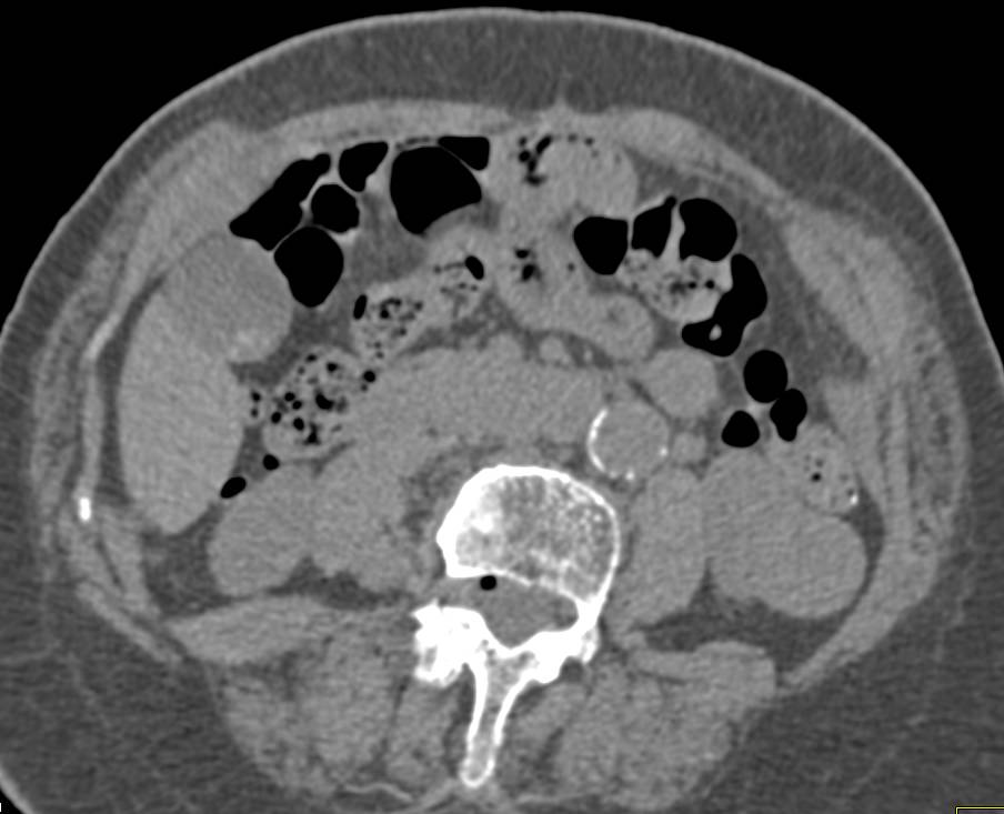 Incidental Papillary Renal Cell Carcinoma Lower Pole Left Kidney - CTisus CT Scan