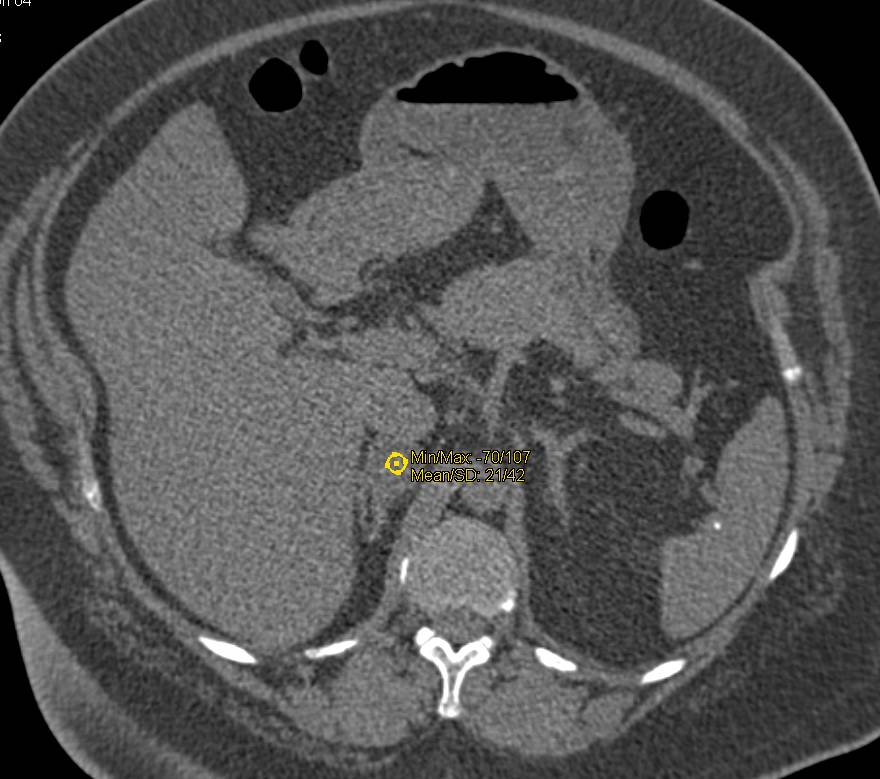 Renal Abscess Simulates a Papillary Renal Cell Carcinoma (RCC) - CTisus CT Scan