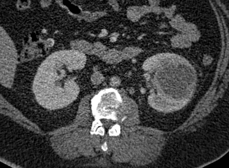 Renal Abscess Simulates a Hypovascular Renal Cell Carcinoma - CTisus CT Scan