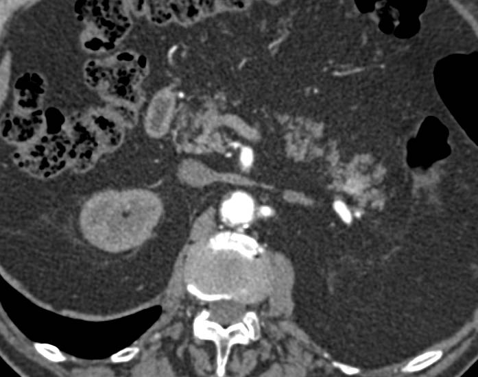 Renal Cell Carcinoma Left Kidney with Metastases to Tail of Pancreas - CTisus CT Scan