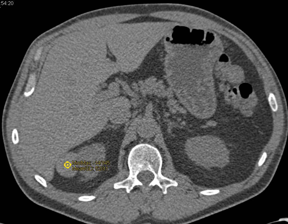 High Density Cyst off the Right Kidney - CTisus CT Scan