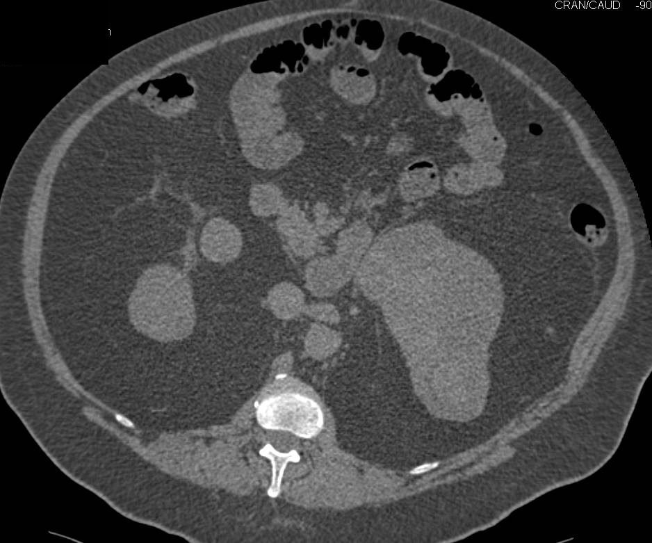 Cystic Left Renal Cell Carcinoma - CTisus CT Scan