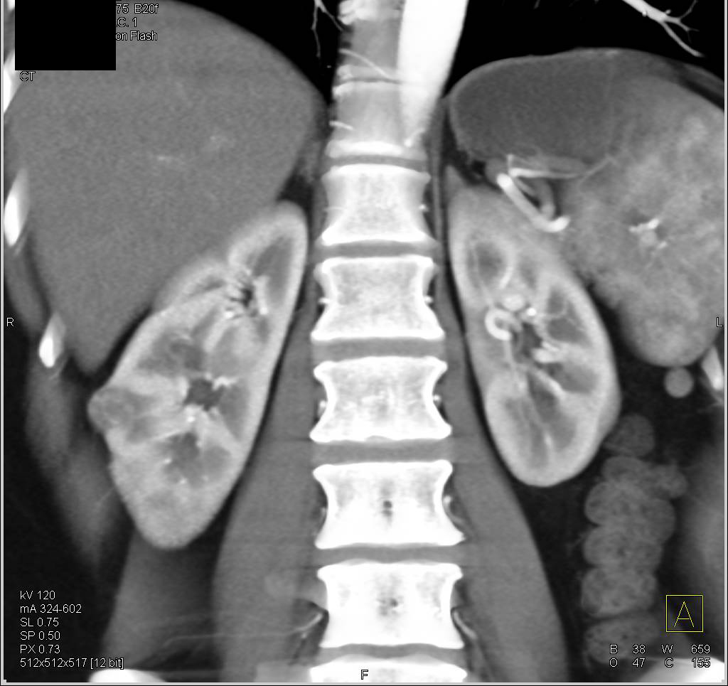 1 cm Renal Cell Carcinoma Lateral Aspect Right Kidney. Duplicated Collecting System as Well - CTisus CT Scan