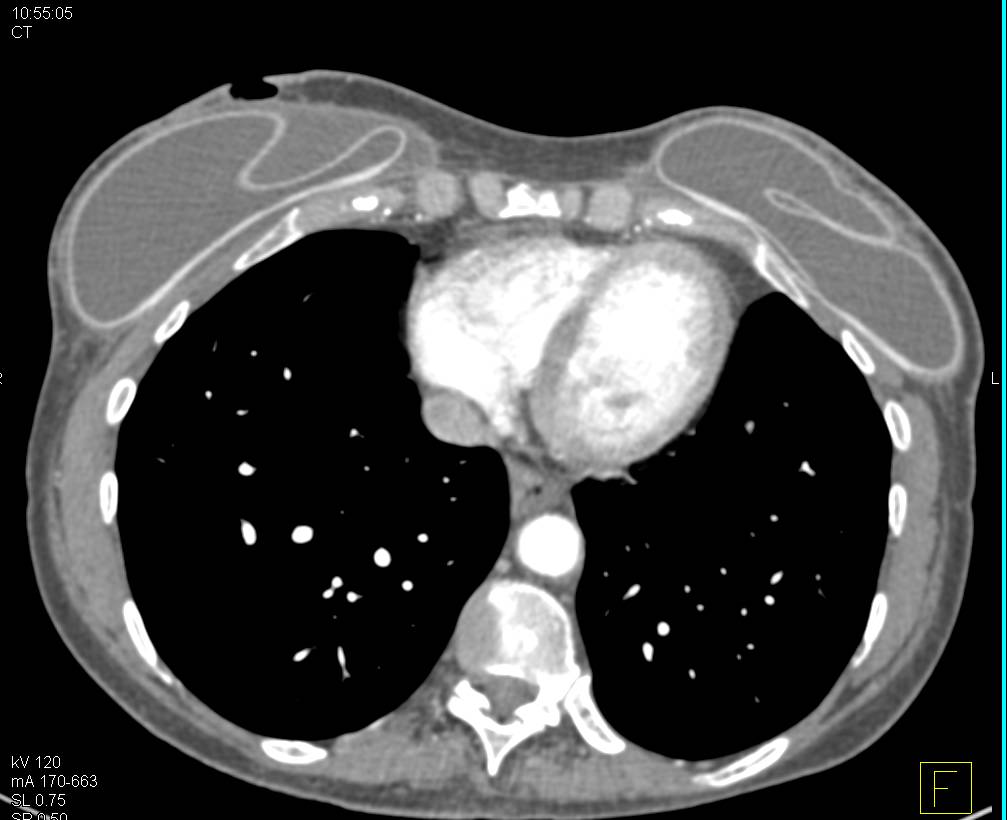 Positioning of Left Kidney s/p Splenectomy - CTisus CT Scan