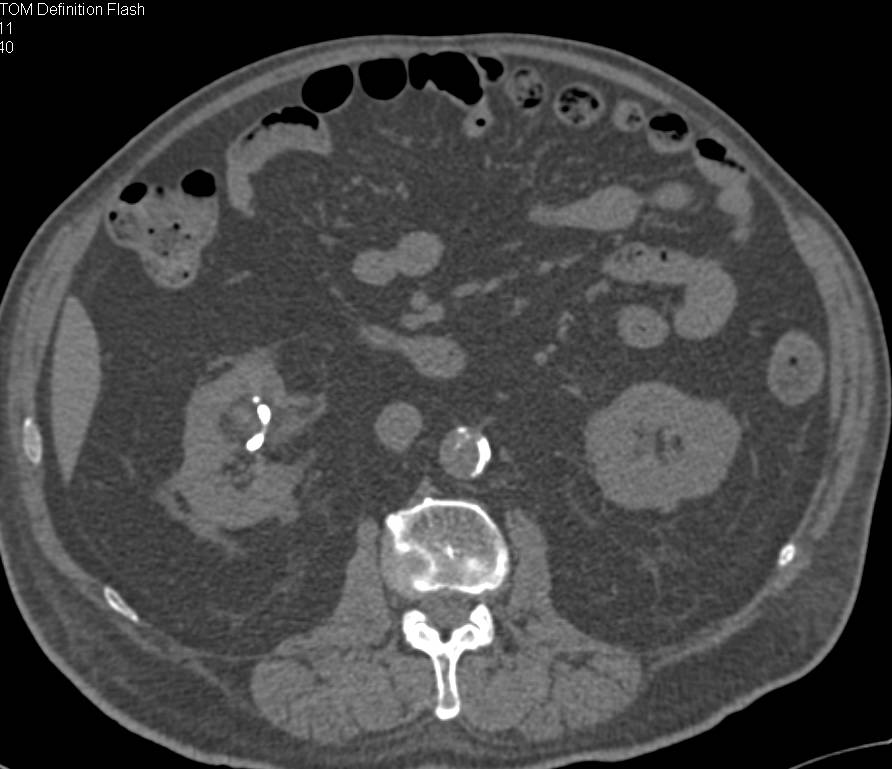 Pigtail Catheter Used to Treat a Renal Abscess - CTisus CT Scan