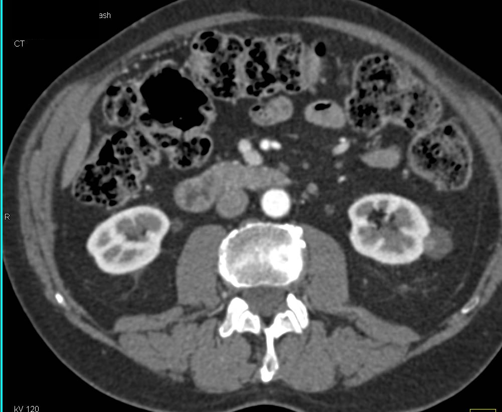 Subtle Left Cystic Renal Cell Carcinoma-See Measurements - CTisus CT Scan