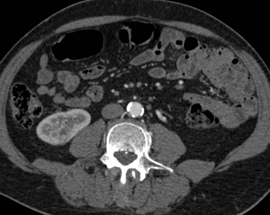 Subtle Papillary Renal Cell Carcinoma Sent Best on Late Phase Images. Patient Also has a Hemangioma in the Liver - CTisus CT Scan