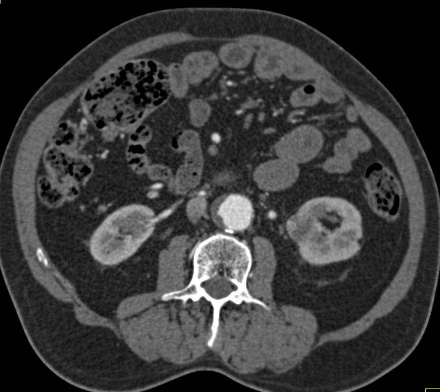 Incidental Renal Cell Carcinoma Lower Pole Left Kidney - CTisus CT Scan