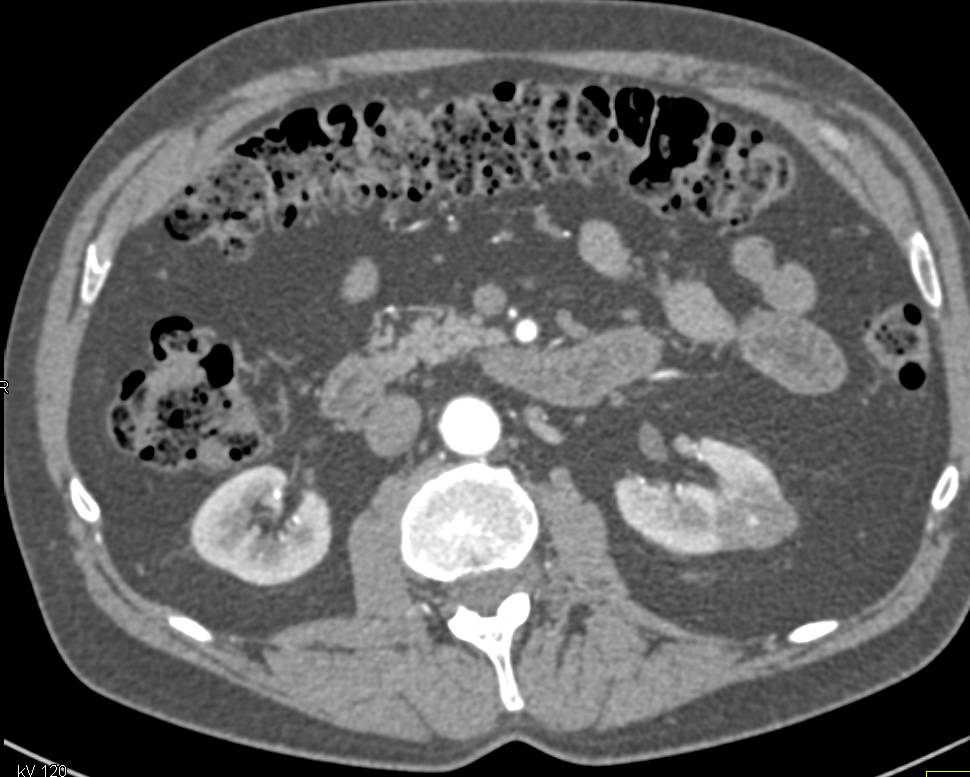 Papillary Renal Cell carcinoma Left Kidney - CTisus CT Scan