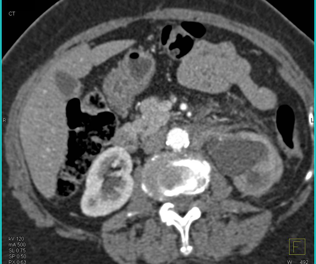 Left Hydronephrosis due to Retroperitoneal Fibrosis - CTisus CT Scan